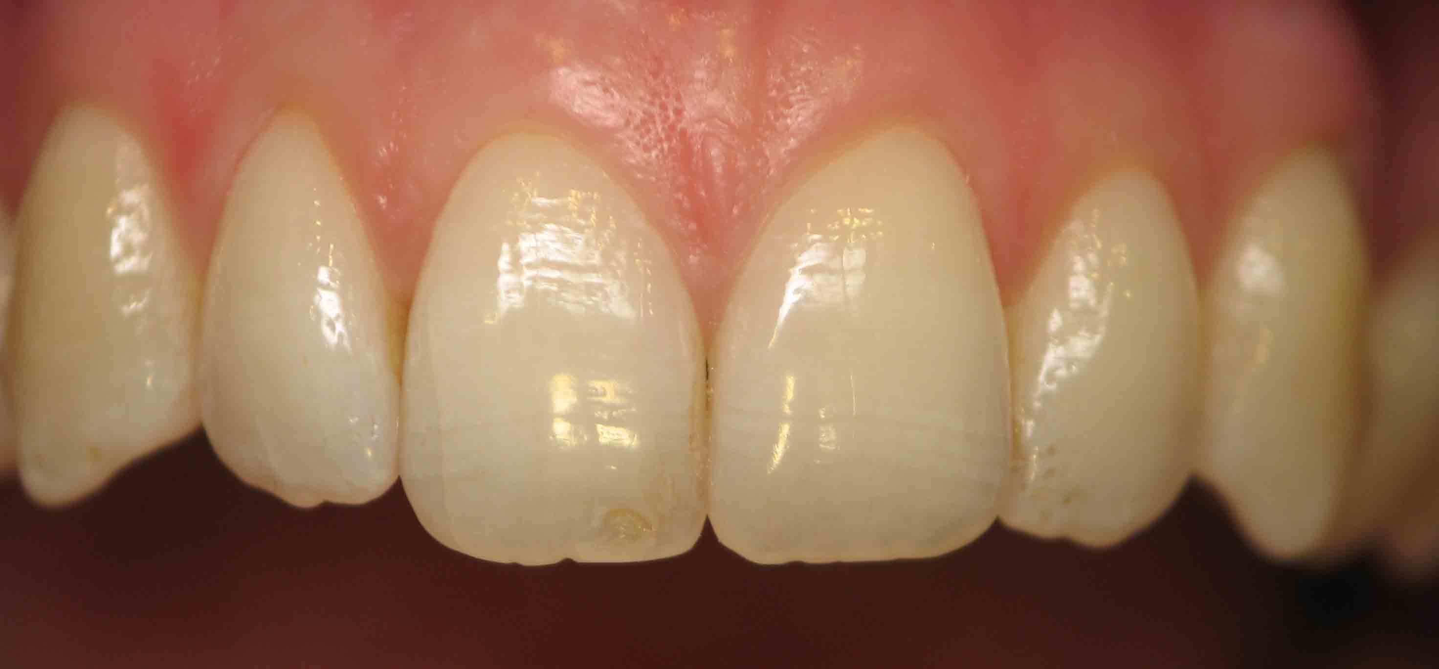 After orthodontic treatment